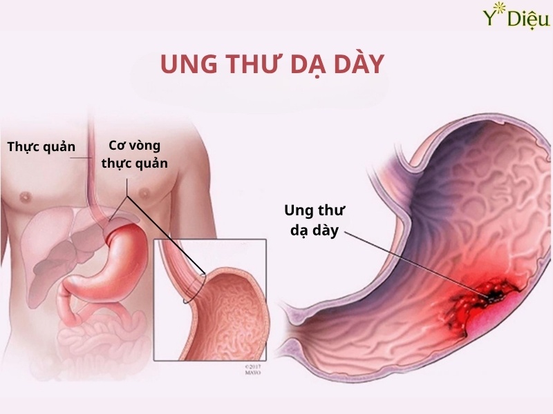 Ung Thư Dạ Dày: Nguyên Nhân, Triệu Chứng Và Điều Trị